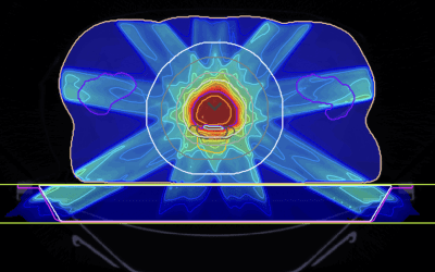 Radiation Therapy Treatment Planning via Inverse Optimization