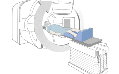 Towards Global Optimality in Stereotactic Radiation Therapy
