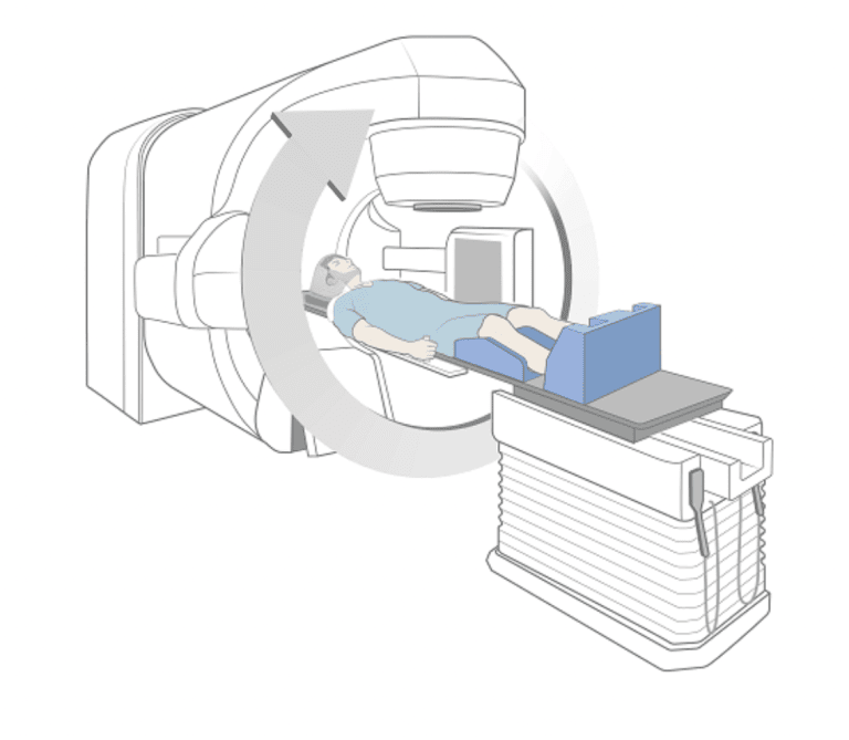 Towards Global Optimality in Stereotactic Radiation Therapy